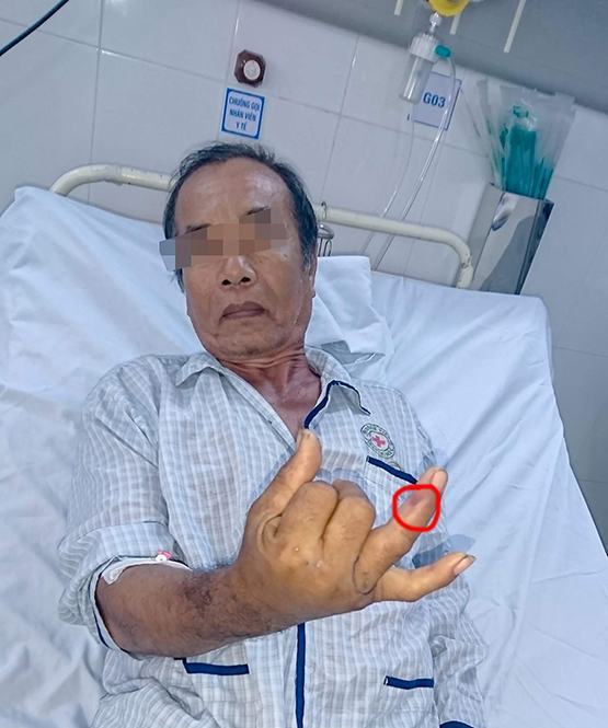 TP.HCM: Báo động rắn lục đuôi đỏ cắn người tại Q.Thủ Đức