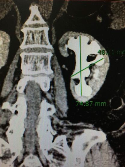 Một bệnh nhân bị sỏi san hô chiếm hết toàn bộ thận