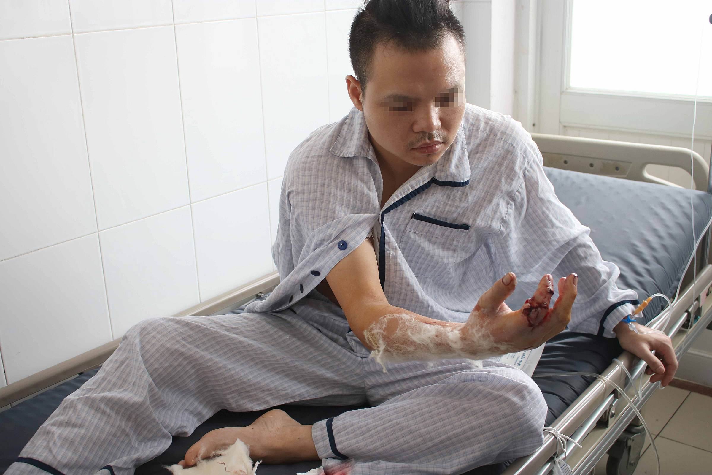 Nối thành công ngón tay đứt lìa bằng kỹ thuật vi phẫu