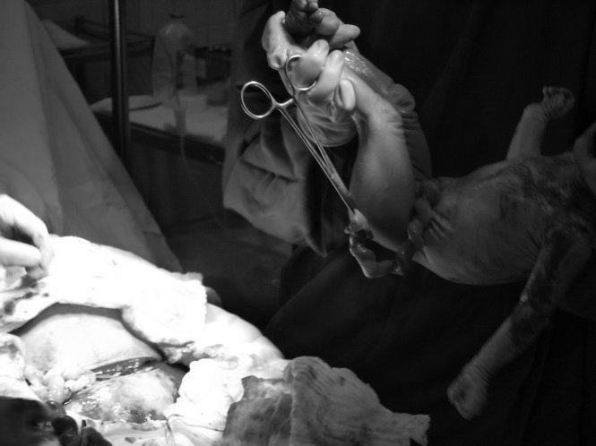 Tại sao không gây tê mổ đẻ nữa?