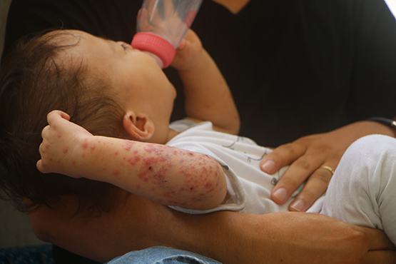 Nhiều trẻ mầm non mắc bệnh tay chân miệng