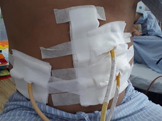 Cứu sống kịp thời một bệnh nhân “vỡ tạng” do ngã từ giàn giáo tầng 2