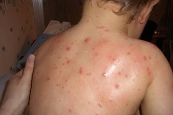 Phòng bệnh thủy đậu cho trẻ em ngay từ bây giờ