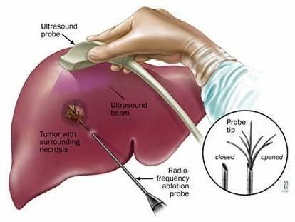 Tin vui cho bệnh nhân ung thư