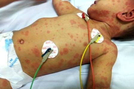 TP.HCM: Một bệnh nhi tử vong do nhiễm não mô cầu