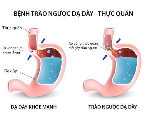 Thuốc trị chứng trào ngược tăng nguy cơ nhiễm trùng dạ dày