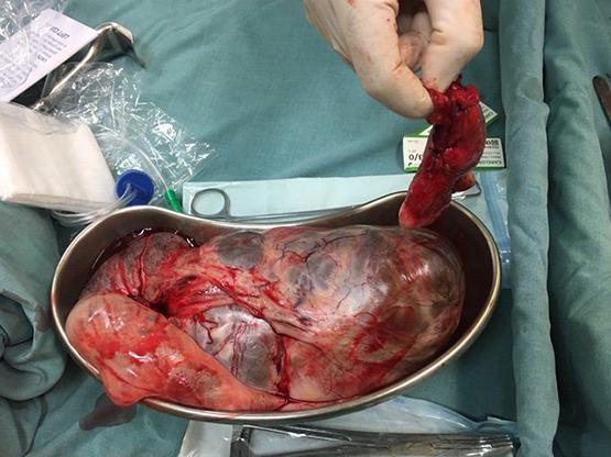 Tưởng mang thai 6 nhưng bị u bọc dịch hiếm gặp