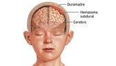 Ứng cứu với chấn thương sọ não