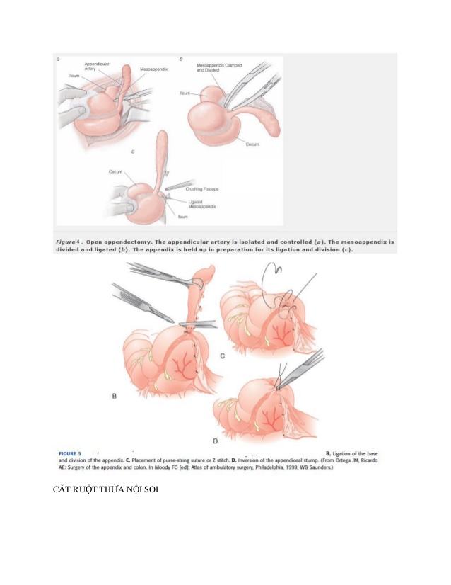 Điều trị nội khoa viêm ruột thừa cấp: Hơn 90% bệnh nhân không phải phẫu thuật
