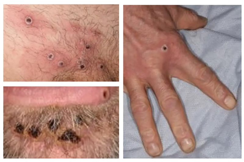 Virus gây đậu mùa khỉ đột biến với tốc độ chưa từng có