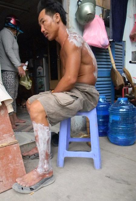 Xì bình gas, 5 người bị bỏng