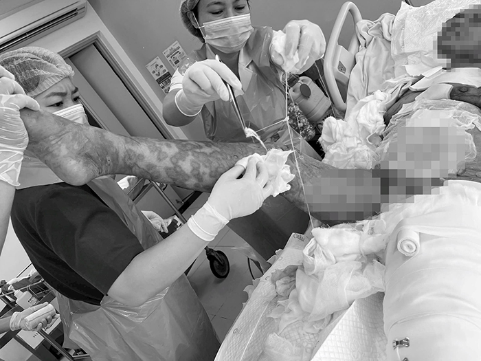Bệnh viện Quân y 175 cứu sống bệnh nhân bị tổn thương da đến 92% do phản ứng thuốc nghiêm trọng