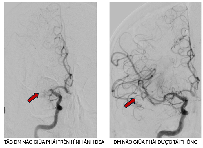 TP.HCM: Cứu sống bệnh nhân người Nga bị đột quỵ nặng