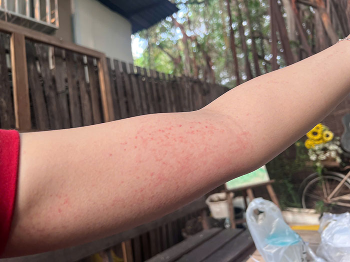 Dịch sốt xuất huyết và tay chân miệng tại TP.HCM có xu hướng giảm